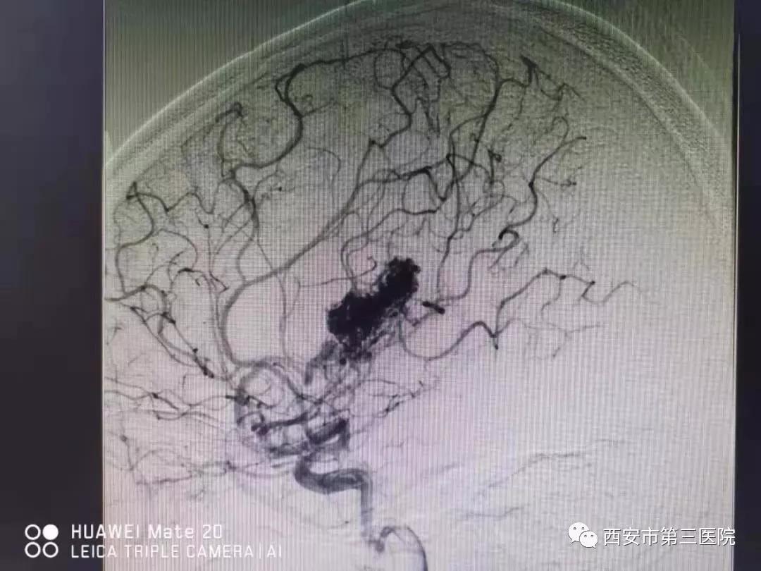 沒有發病時多數人無任何感覺,人們也不會無緣無故去做腦血管造影檢查