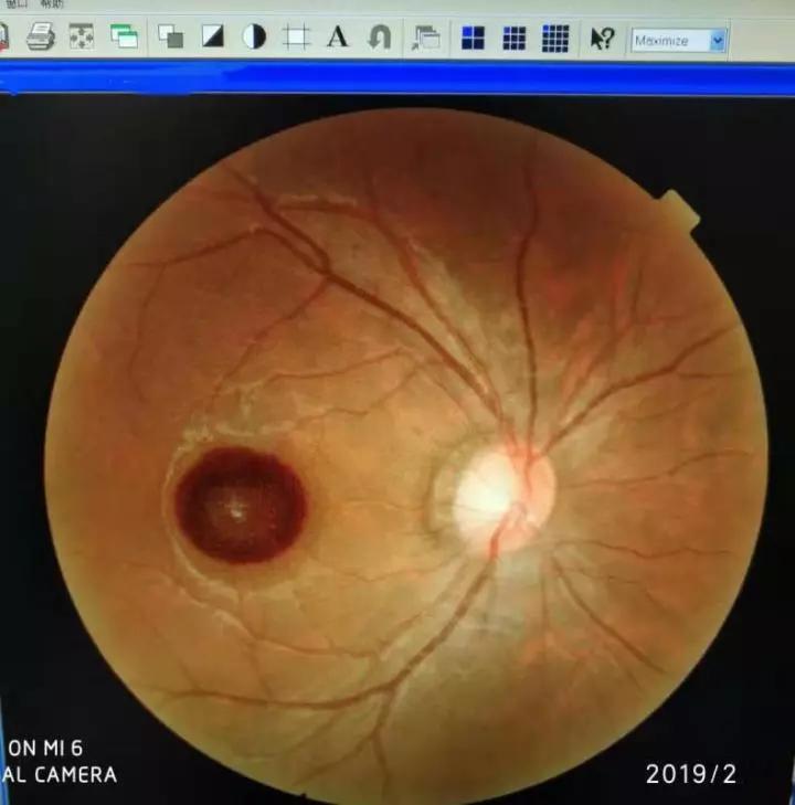 (被激光所伤眼眼底图,患者是去年一位病人,左侧深色圆点为灼伤处.