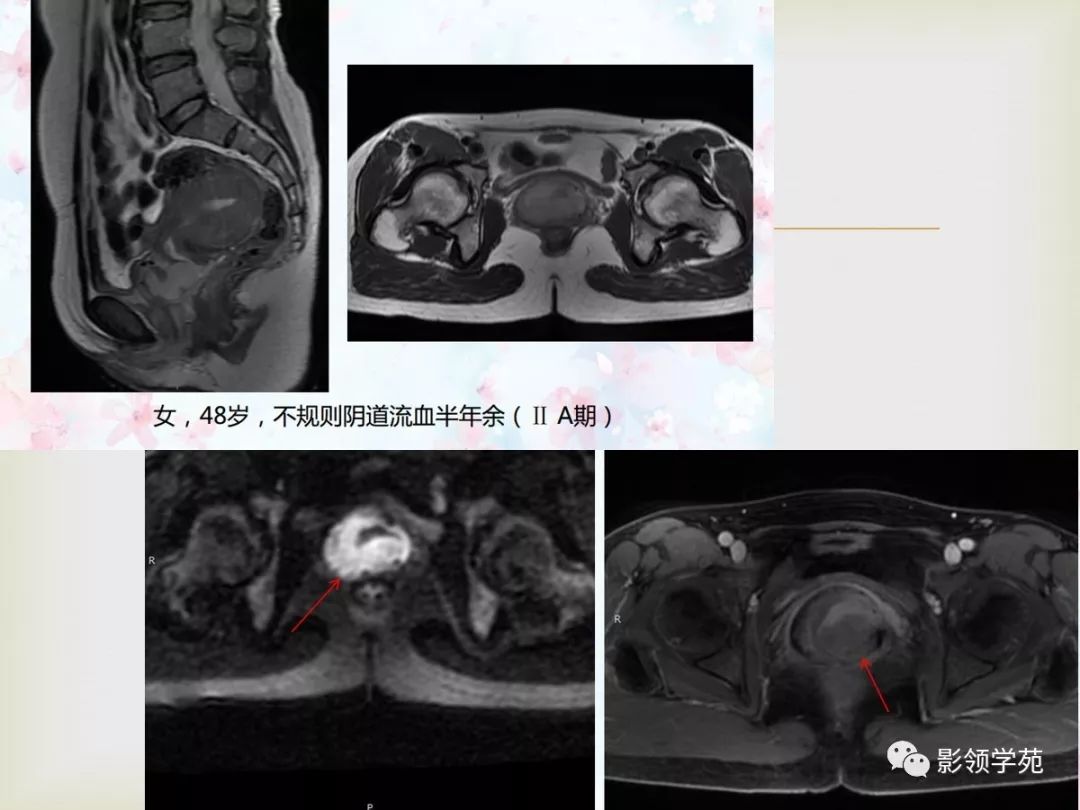 子宫卵巢病变的mri诊断