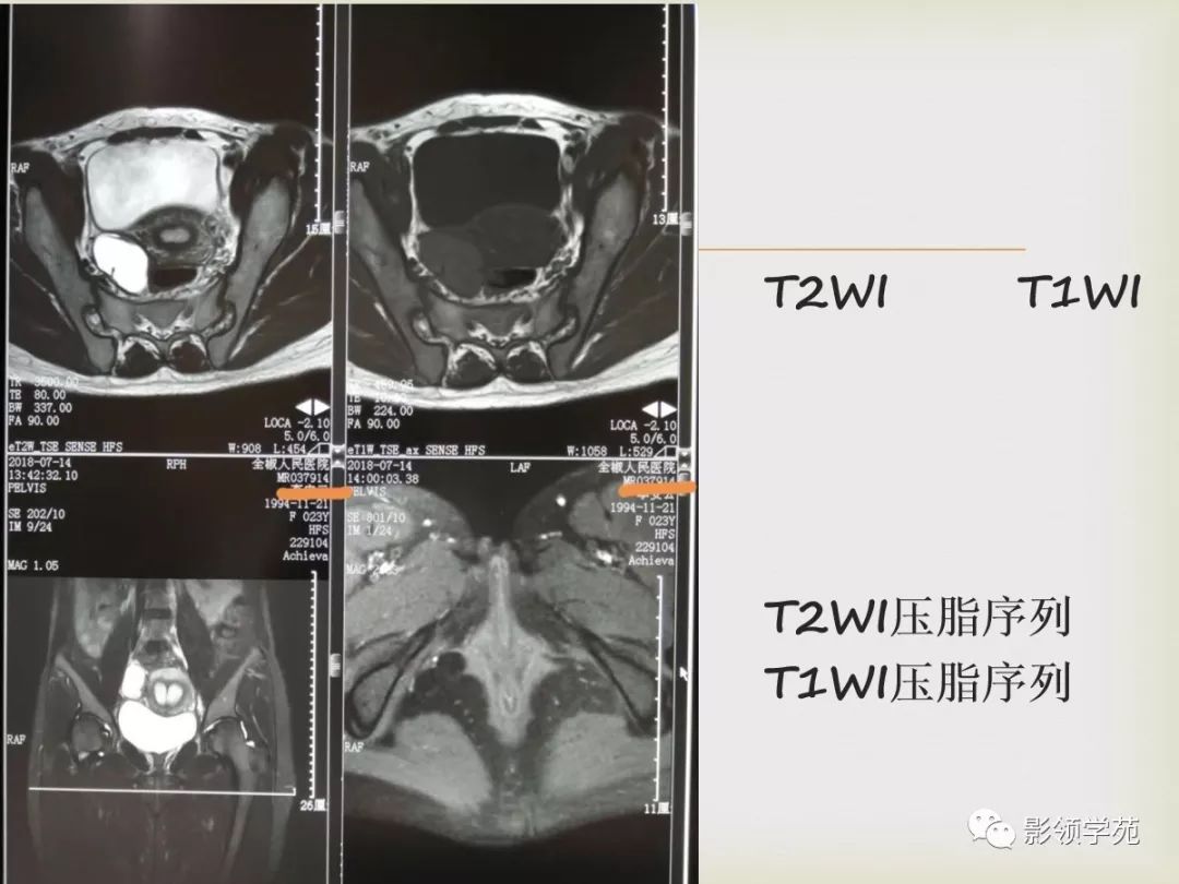 由苏峻 老师讲解的子宫平滑肌瘤的mr诊断与鉴别在影领千聊直播间上线