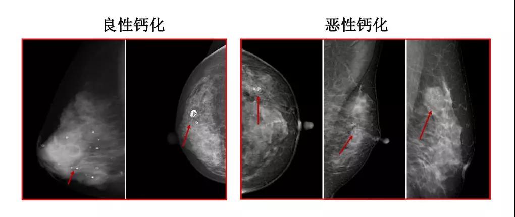 当乳腺结节遇上钙化就是癌吗