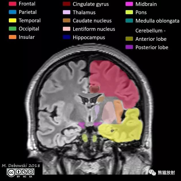 解剖丨腦葉分佈(mri圖像彩色標註)