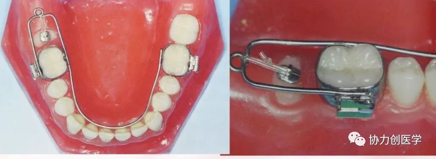 另辟蹊径推吊结合论阻生第二磨牙外科联合正畸牵引术
