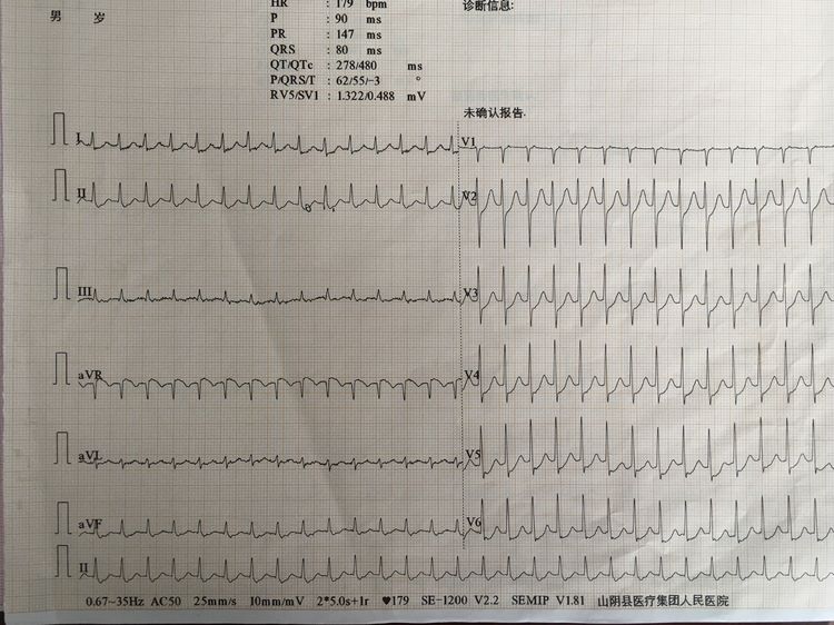 患者尚先生髮作時心電圖