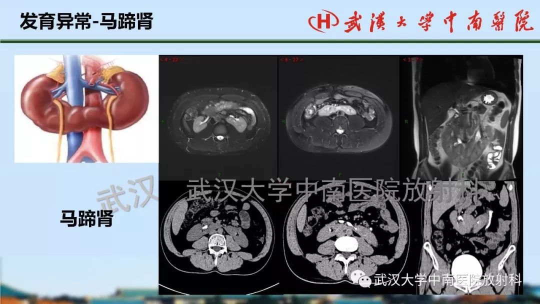 腎臟解剖與實性腫瘤的ctmri診斷梅列軍