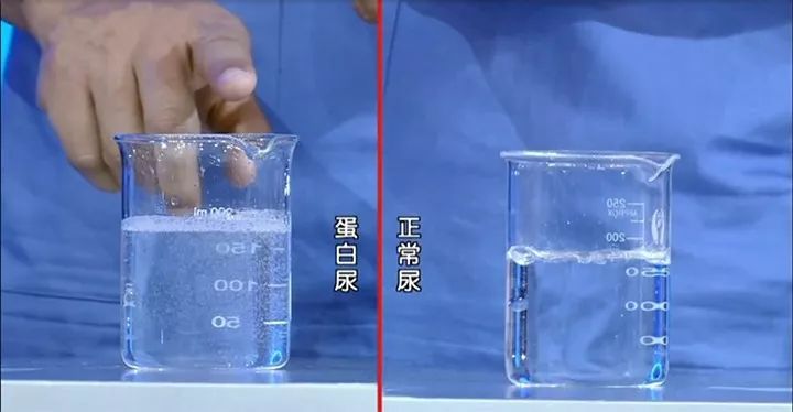 正常人也会排出泡沫尿,但是这种泡沫尿的泡比较大,很快就会消失;而