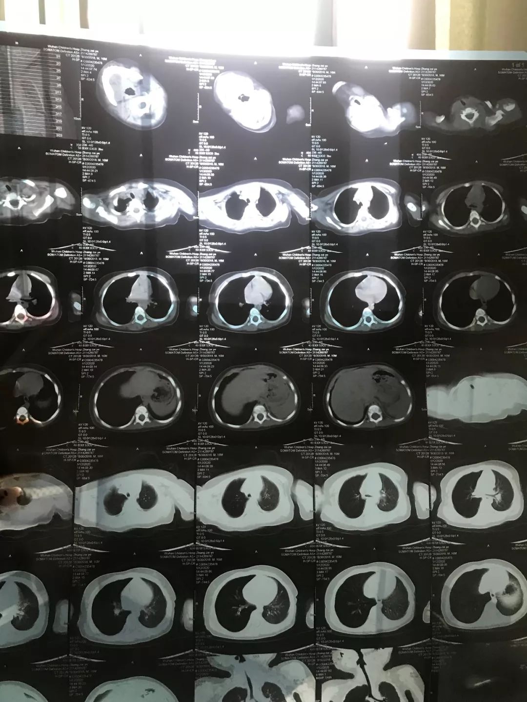 才1岁多仙桃男孩竟被查出肺部有异物罪魁祸首是它家里有小孩的千万