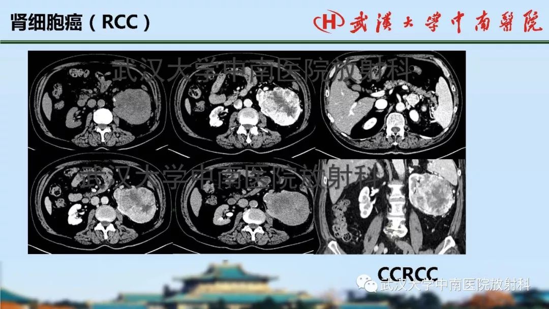 腎臟解剖與實性腫瘤的ctmri診斷梅列軍