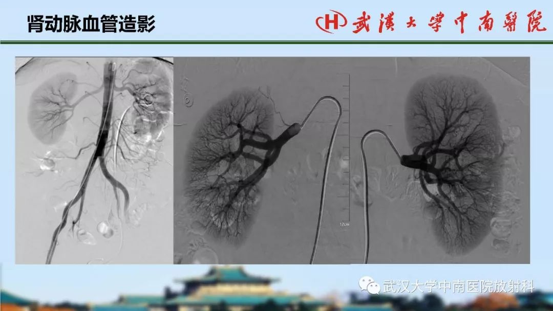 腎臟解剖與實性腫瘤的ctmri診斷梅列軍