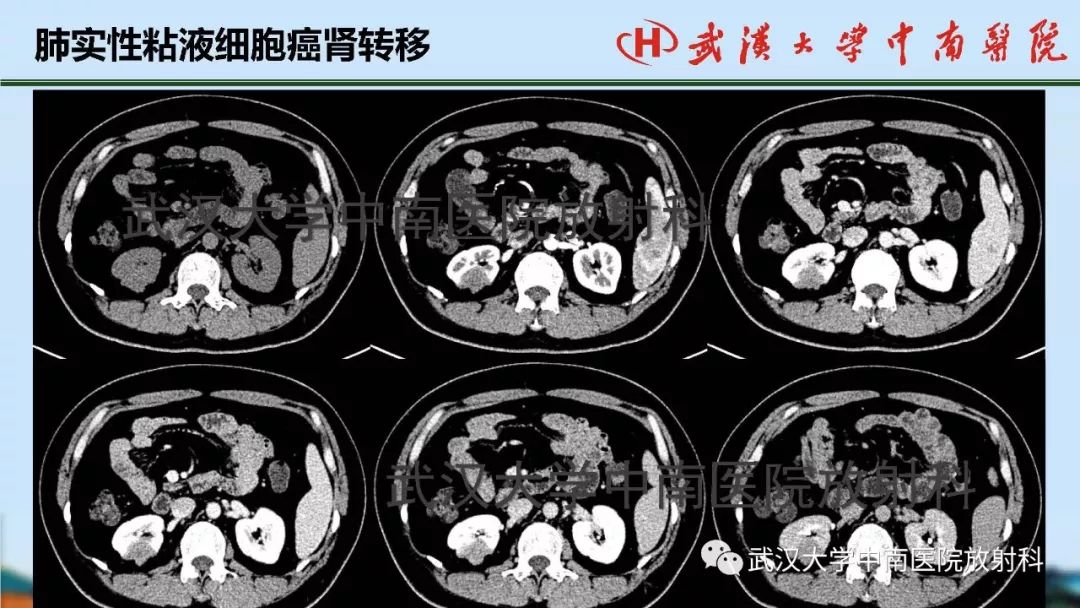 腎臟解剖與實性腫瘤的ctmri診斷梅列軍