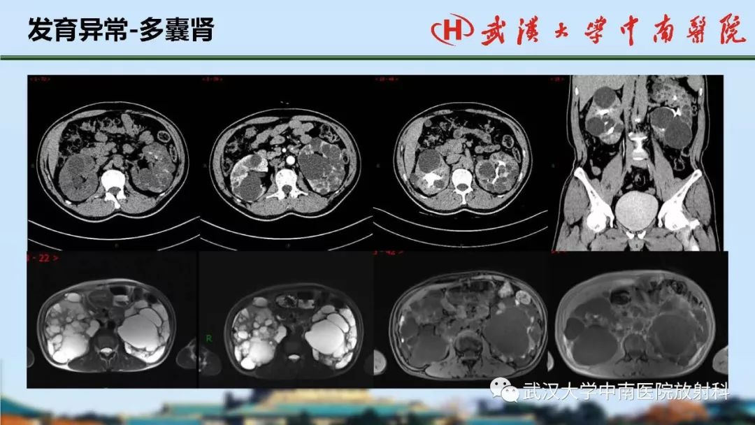 腎臟解剖與實性腫瘤的ctmri診斷梅列軍