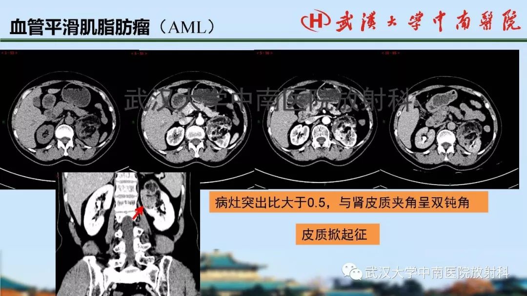 腎臟解剖與實性腫瘤的ctmri診斷梅列軍