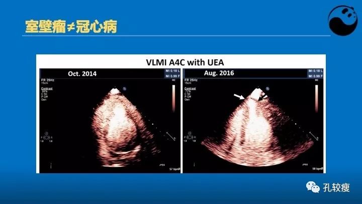 心脏介入医生应该掌握的超声心动图知识