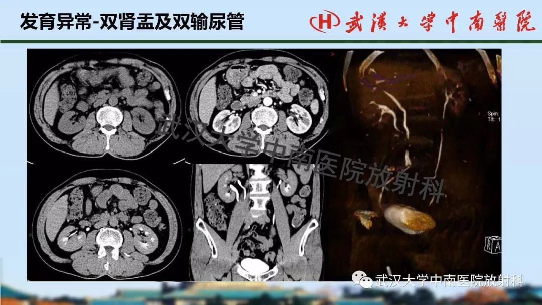 腎臟解剖與實性腫瘤的ctmri診斷梅列軍