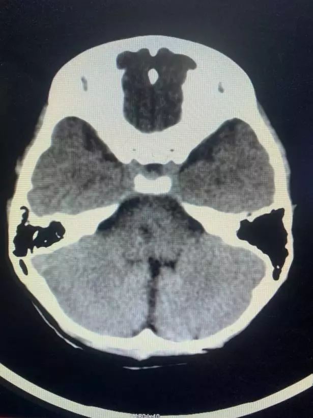 術後複查頭顱ct可見腦幹海綿狀血管瘤已完整切除