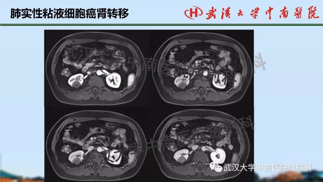 腎臟解剖與實性腫瘤的ctmri診斷梅列軍