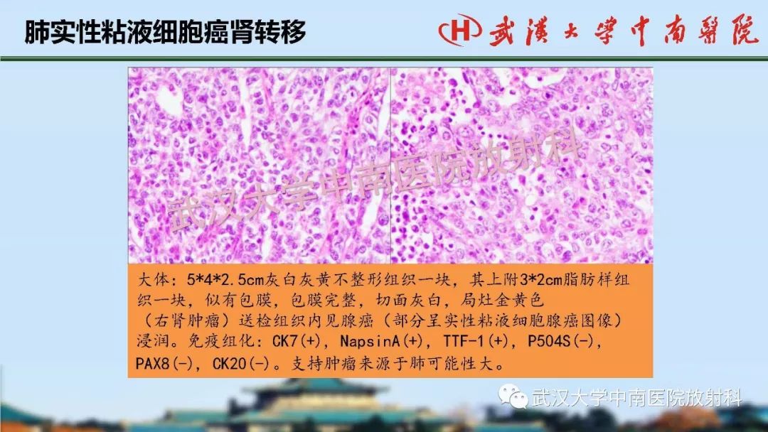 腎臟解剖與實性腫瘤的ctmri診斷梅列軍