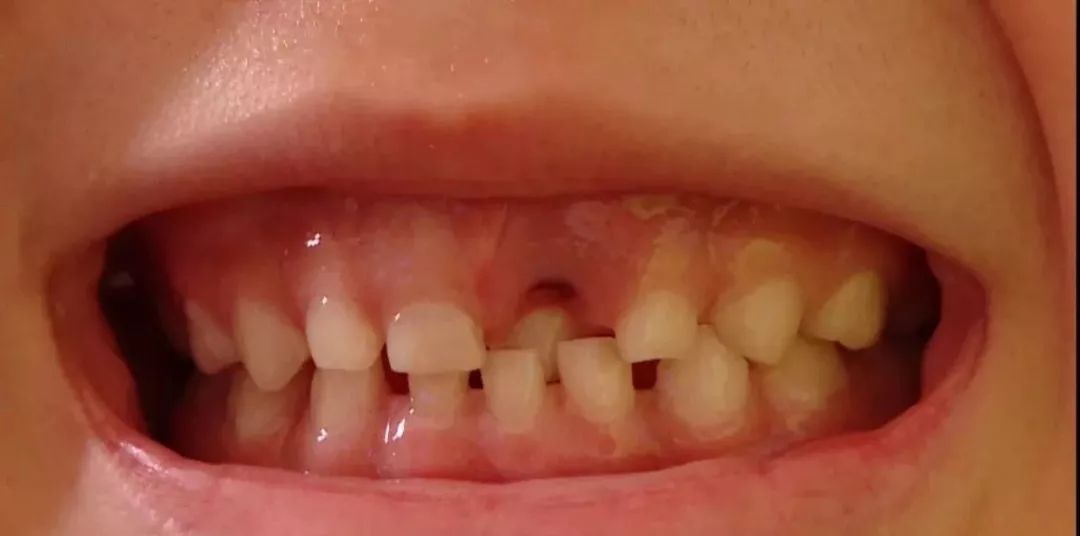 可小雨刚拔完牙,妈妈一看就懵了,怎么多生牙没事,倒是乳门牙被拔了.