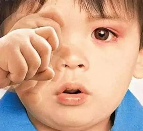 爱诺刻孩子近视的原因还有不同的额眼体质