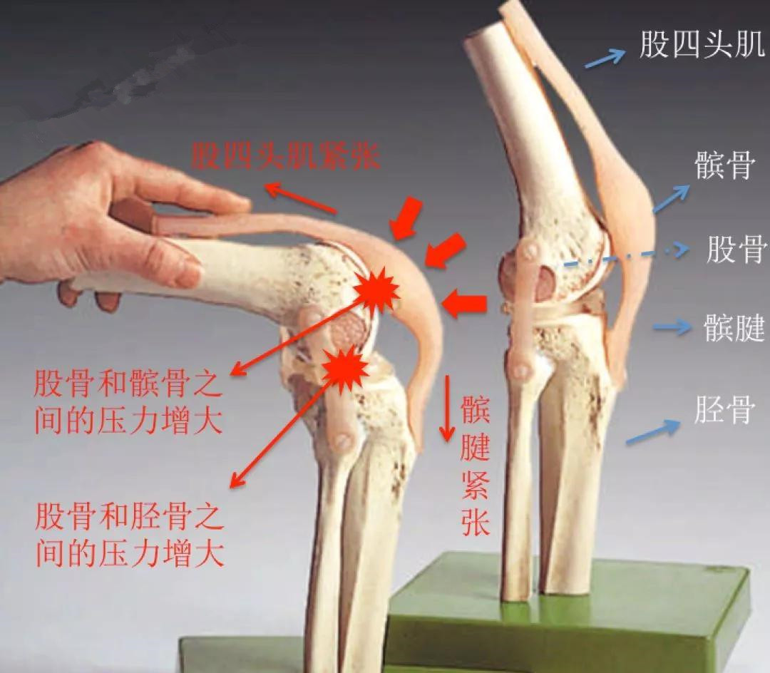 其中髌骨上面连着股四头肌,下面连着髌腱,是膝关节活动的滑轮装置