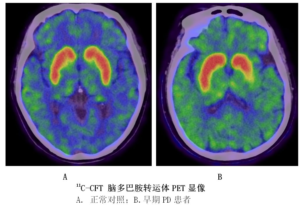 微谈21期宋普姣11ccft脑多巴胺转运体pet显像在帕金森病诊断中的临床