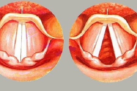 首大計成:聲帶息肉早期症狀都有哪些 預防要養成正確的說話方式_發聲