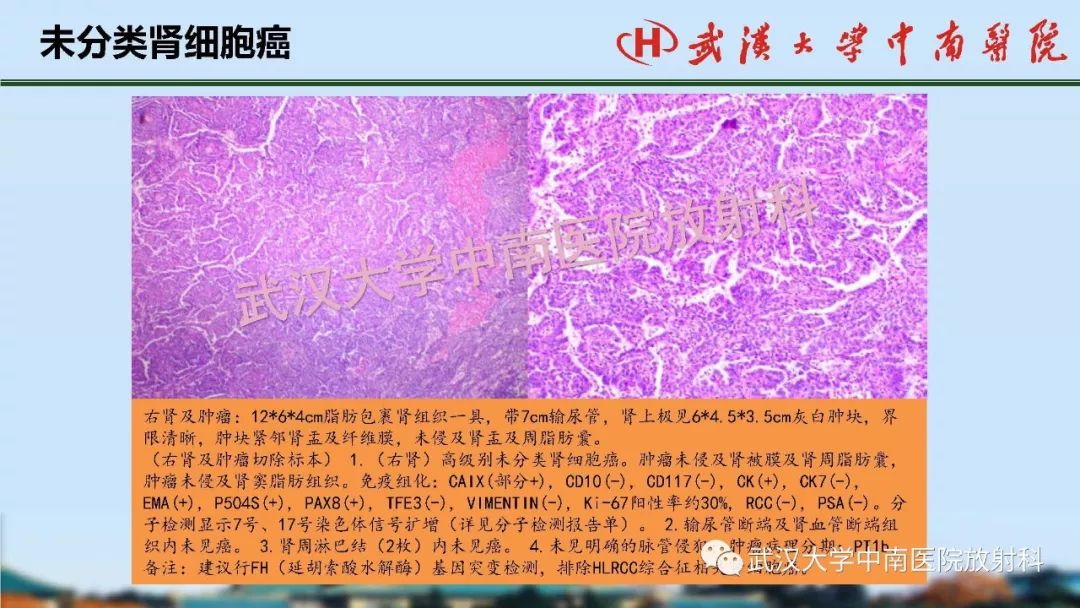 腎臟解剖與實性腫瘤的ctmri診斷梅列軍