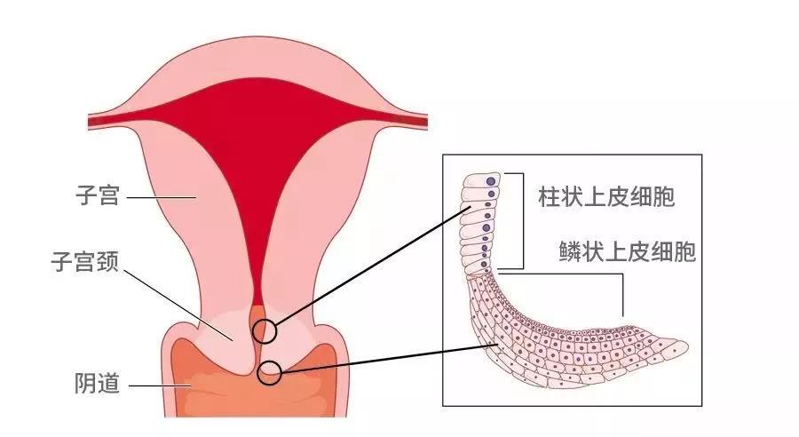 宫颈癌的几个真像你知道吗