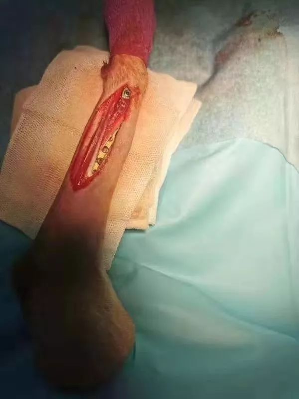 【病例分享】贵宾桡尺骨远端开放性骨折,prcl锁定骨板系统病例分享