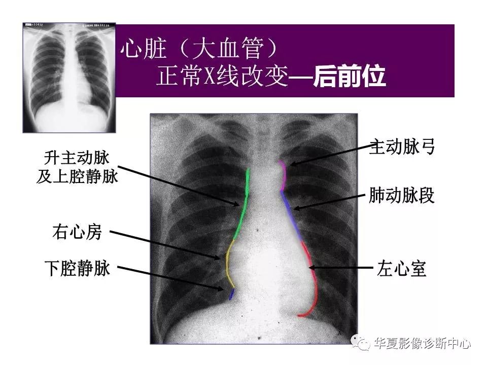 心脏大血管的影像解剖对照