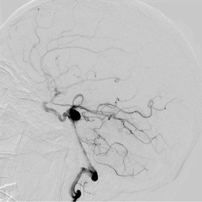 新医神外双周刊第二期一例原始三叉动脉伴动脉瘤病例分享