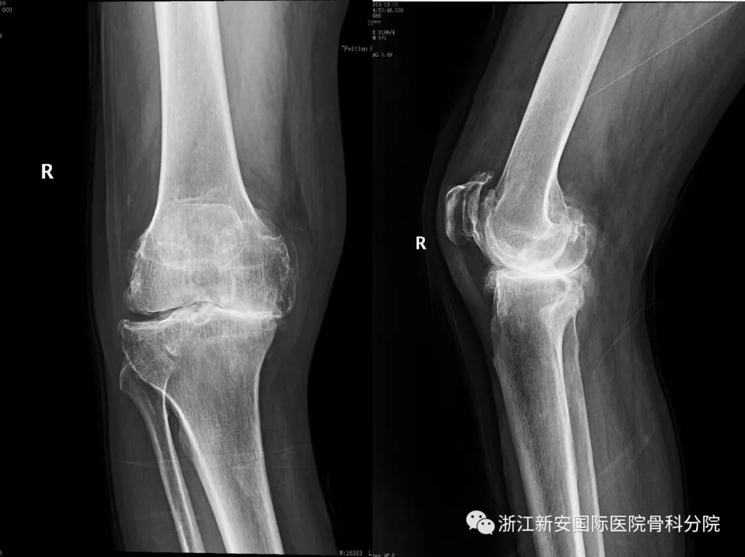膝骨关节炎专题二严重畸形的膝关节也能让你恢复正常