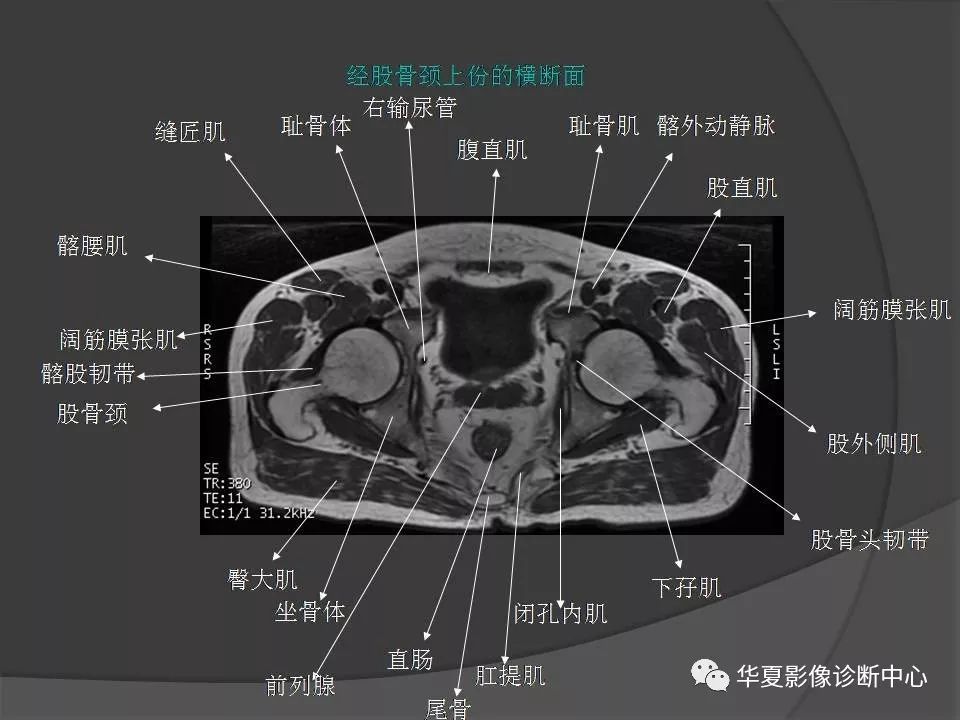 骨盆肌肉解剖mri标识