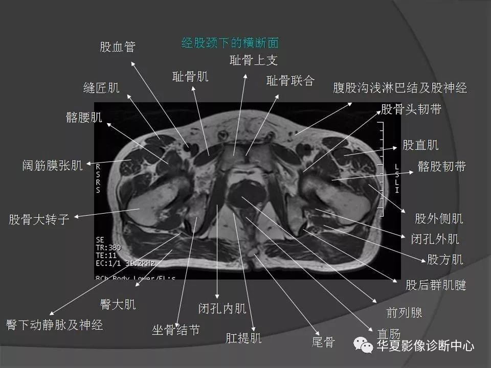 骨盆肌肉解剖mri标识