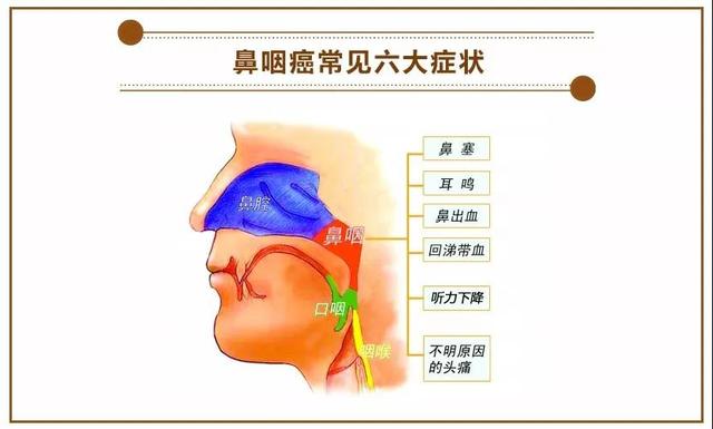 鼻咽癌是癌中之王图片