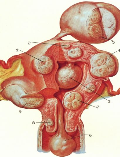 妇科开腹手术创伤大痛苦多阴式手术了解一下