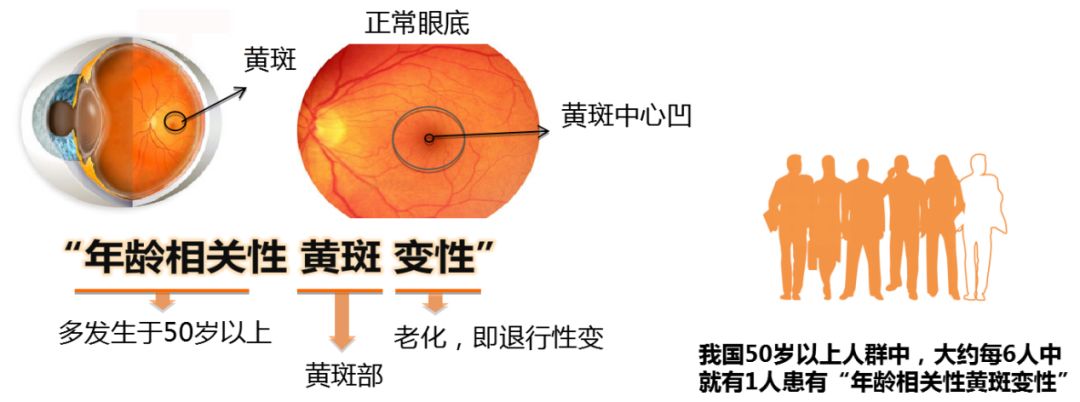 重磅!自體細胞來源的視網膜幹細胞治療黃斑變性的臨床項目即將開啟