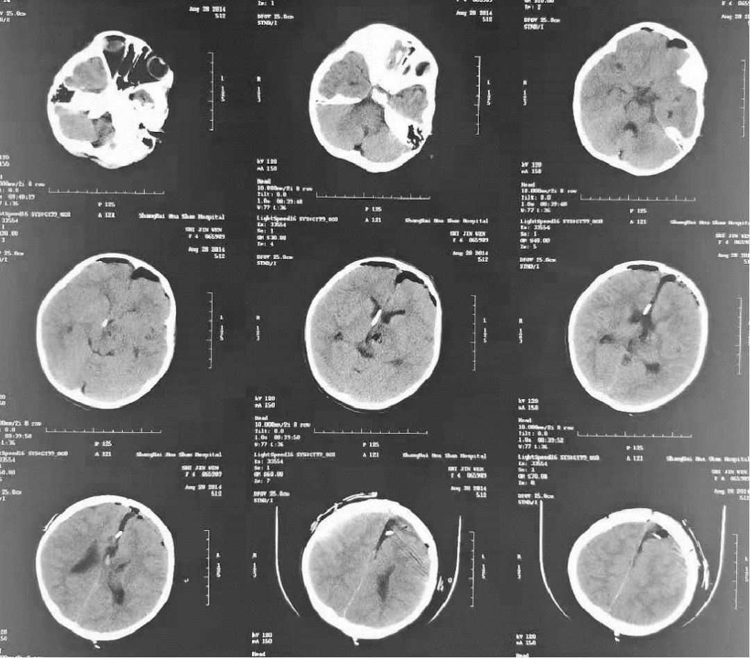 张义教授团队丘脑复发胶质母细胞瘤的手术治疗