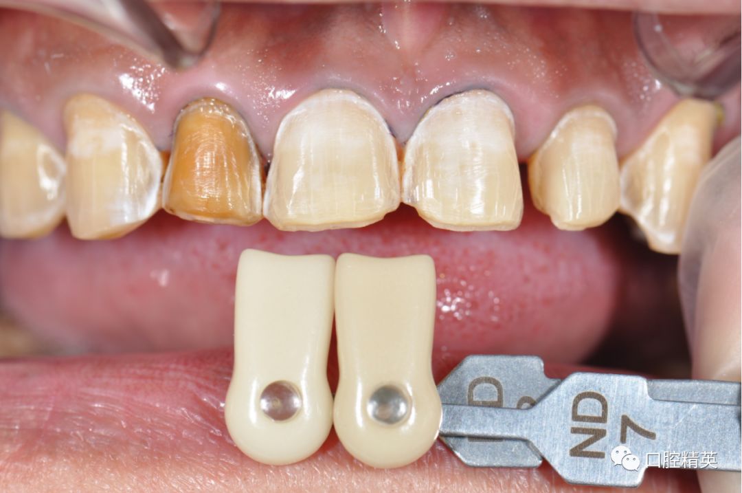 前牙颜色暗黄,部分牙体缺损,局部脱矿,散在间隙,为其采取瓷贴面修复