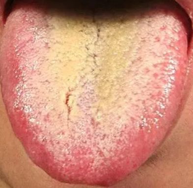 舌头中间有裂纹,或者边缘有齿痕等,是『大病征兆』?现在知道还不晚!