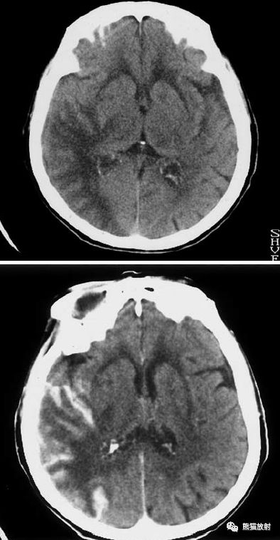 出血性腦梗死上矢狀竇血栓形成,呈高密度