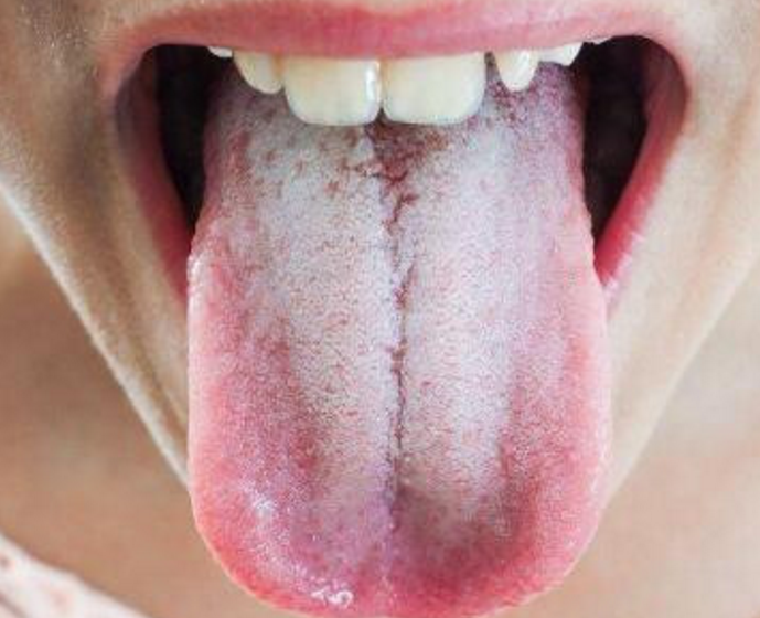 舌头的几种表现应该警惕健康风险了