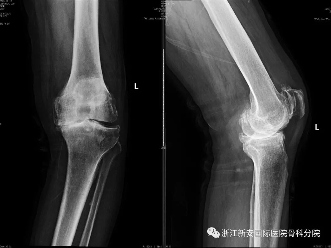 術前x線患者沈師傅,64歲,因