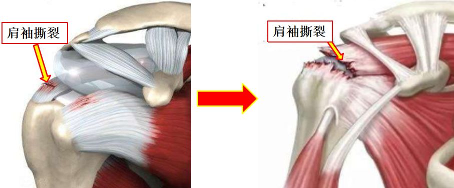 筋骨堂知否知否肩袖撕裂小洞不補大洞吃苦