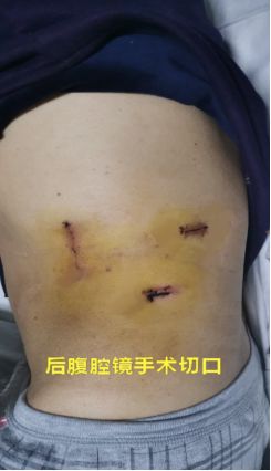 【硬实力】大病"小"治,举重若轻_手术