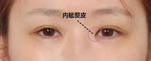 为什么我开了眼角后反而变丑了还留疤了这可咋整