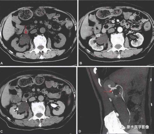鉴别诊断肾盂旁囊肿