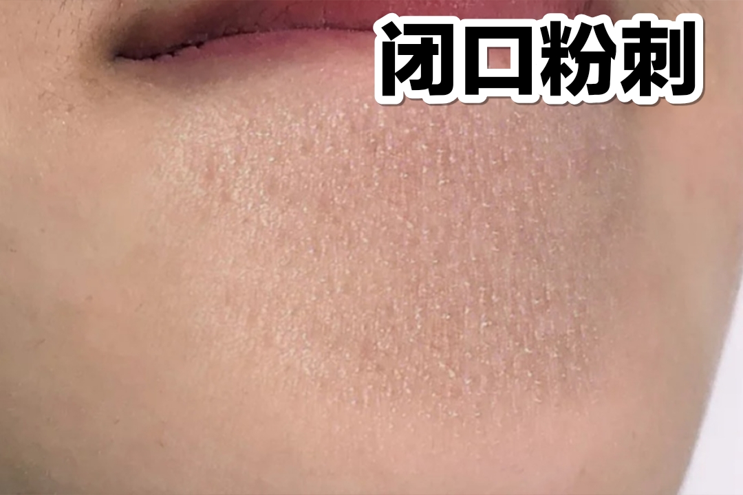 认清痘痘类型,宿系之源让你痘痘无影踪_粉刺