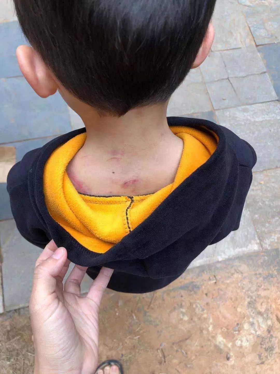 南宁一小男孩遭亲生父亲毒打浑身是伤究竟为何对自己的亲孩子下此狠手