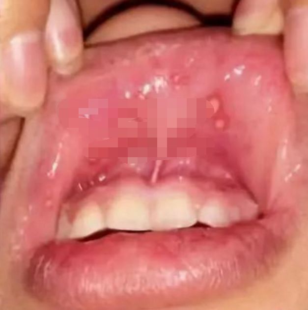 牙床口腔溃疡图片图片
